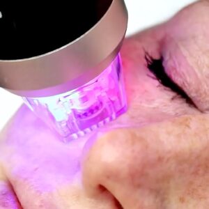 MediRaf RF Microneedling Machine